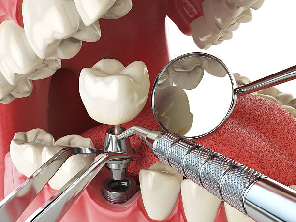 Best Emergency Tooth Extraction in Lake Park, FL